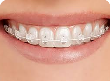 Ästhetische Brackets